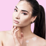 vitiligo treatment